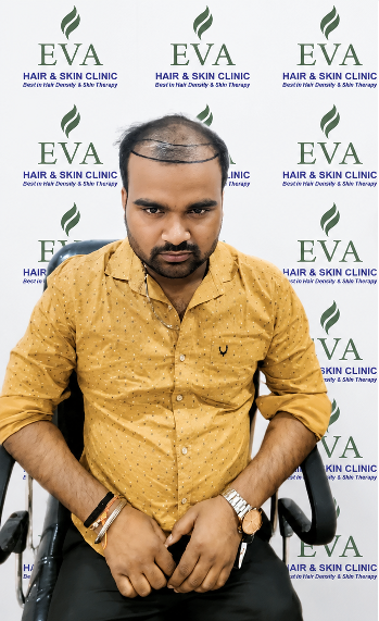 Before hair transplant result 2
